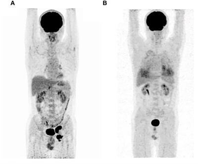 Case report: Disitamab vedotin combined with immunotherapy demonstrated excellent efficacy in scrotal Paget’s disease with Her-2 overexpression